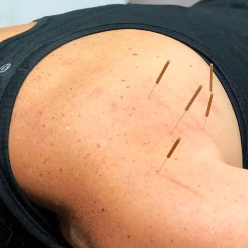 what is dry needling and how can 7dmcs physiotherapists help you